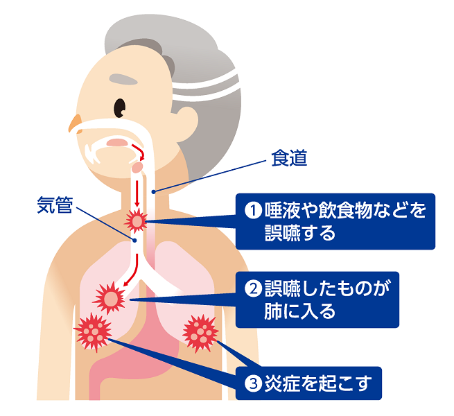 「誤嚥性肺炎」が起こる理由