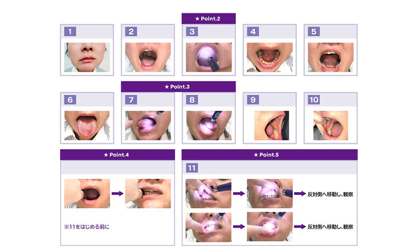 患者さんの口腔内を観察する場合　～日々の検温や口腔ケア介助の前に～
